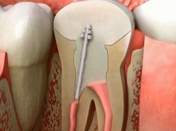 با عصب کشی خداحافظی کنید